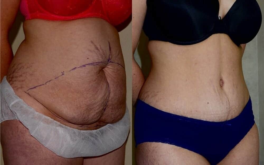 Tummy tuck photos with muscle tightening