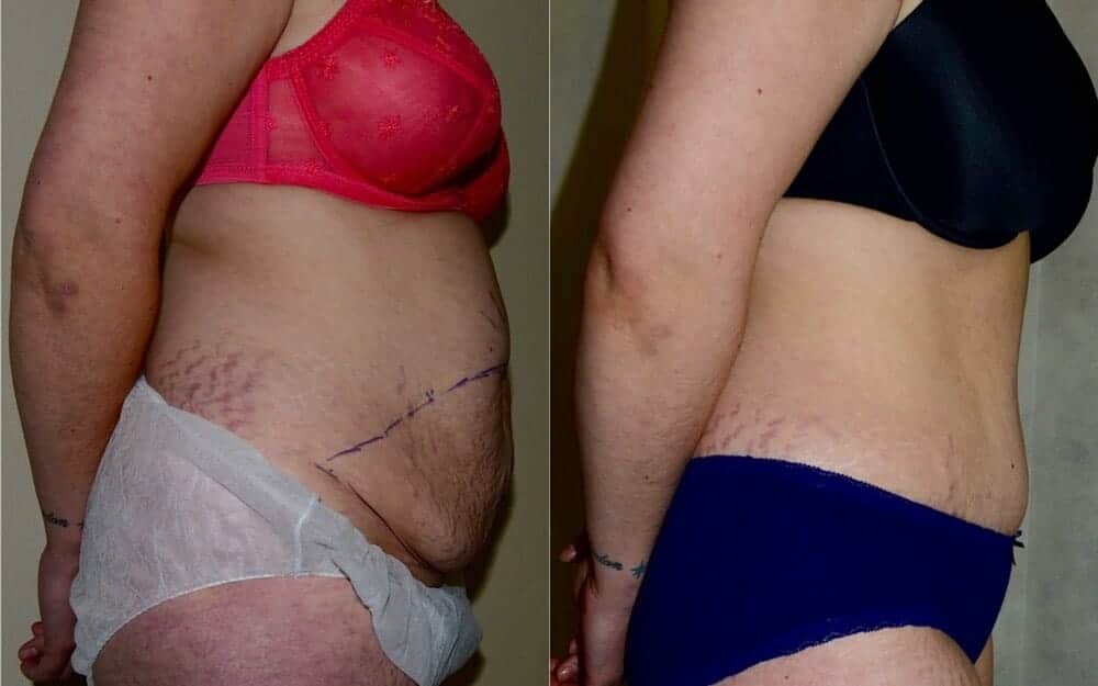 Tummy tuck photos with muscle tightening