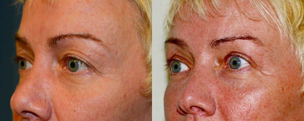 Upper eyelid blepharoplasty