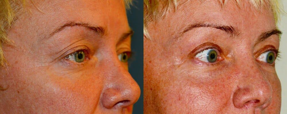 Upper eyelid blepharoplasty