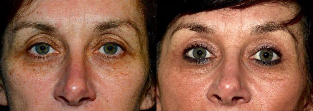 Upper eyelid surgery