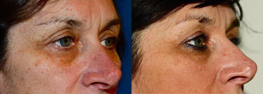 Upper eyelid surgery