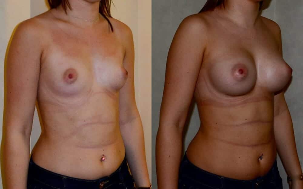 Anatomical implants
