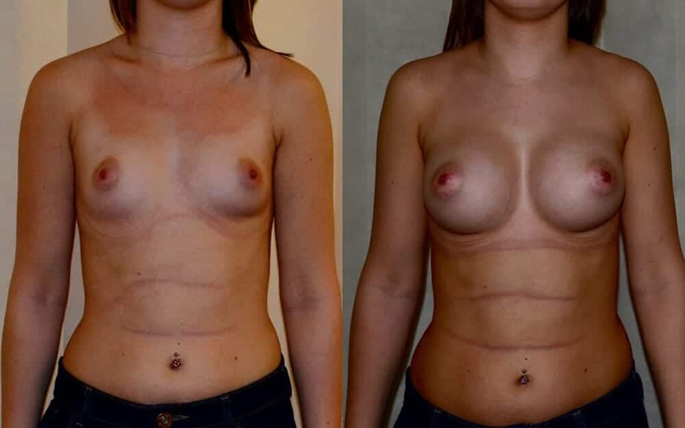 Anatomical implants