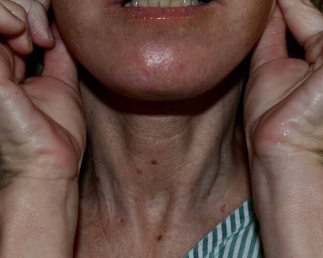 Neck lift