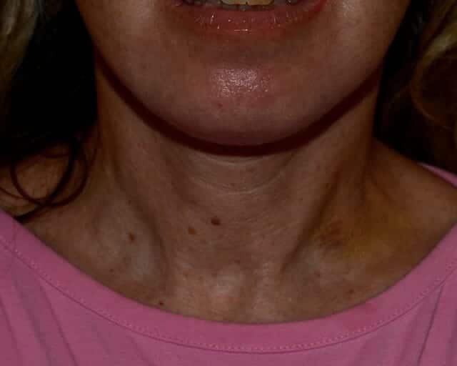 Neck lift