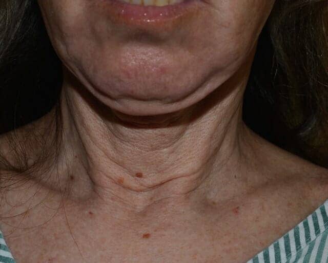 Neck lift