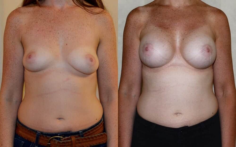 Subfascial breast augmentation