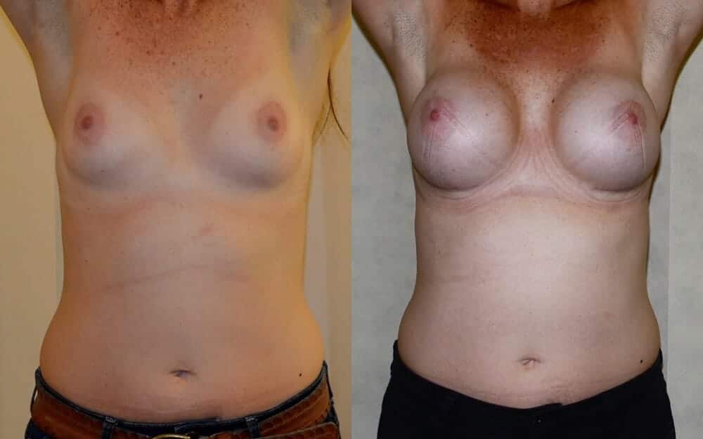 Subfascial breast augmentation
