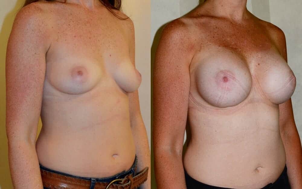 Subfascial breast augmentation