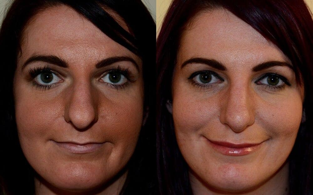 An overall reduction in the size of nose