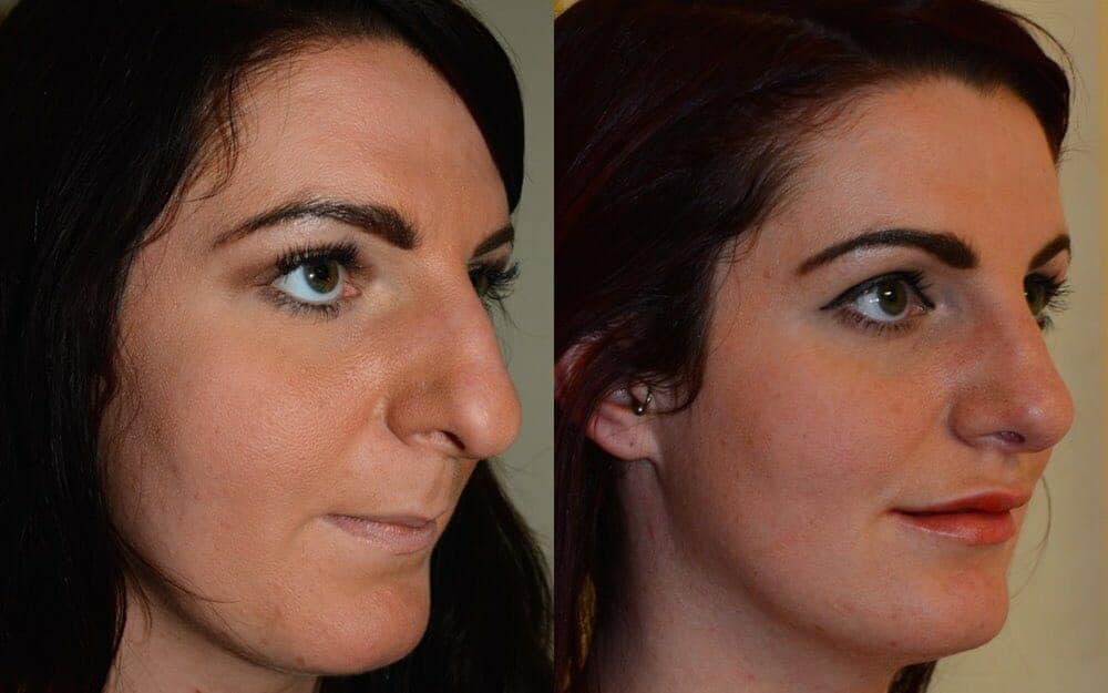 An overall reduction in the size of nose