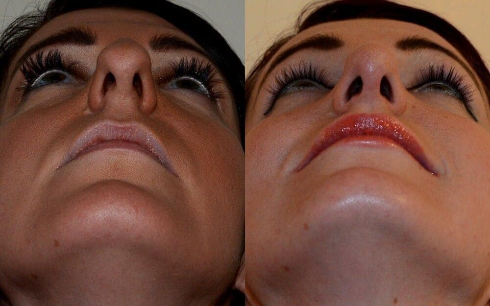 An overall reduction in the size of nose