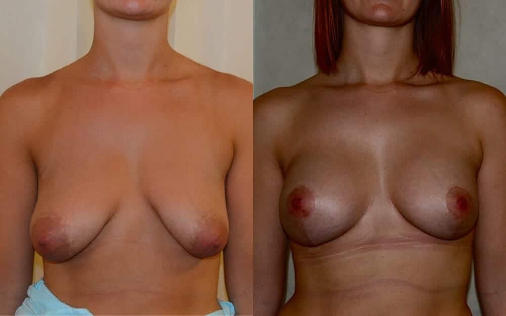 Tubular breast correction with implants
