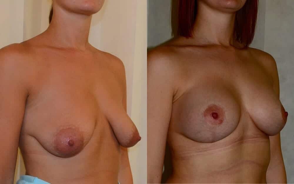 Tubular breast correction with implants