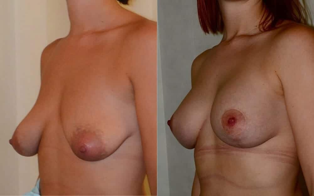 Tubular breast correction with implants