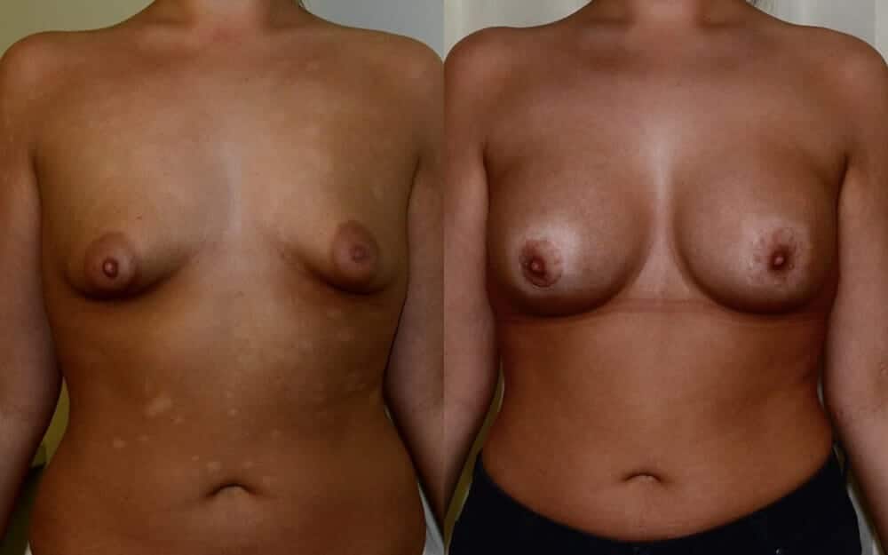Tubular breast correction with breast implants