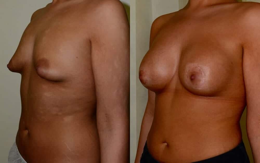 Tubular breast correction with breast implants