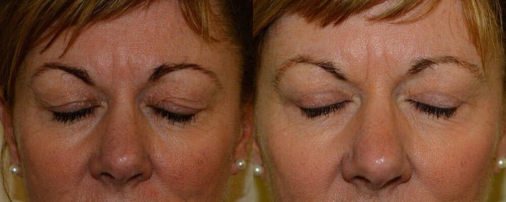 Upper blepharoplasty