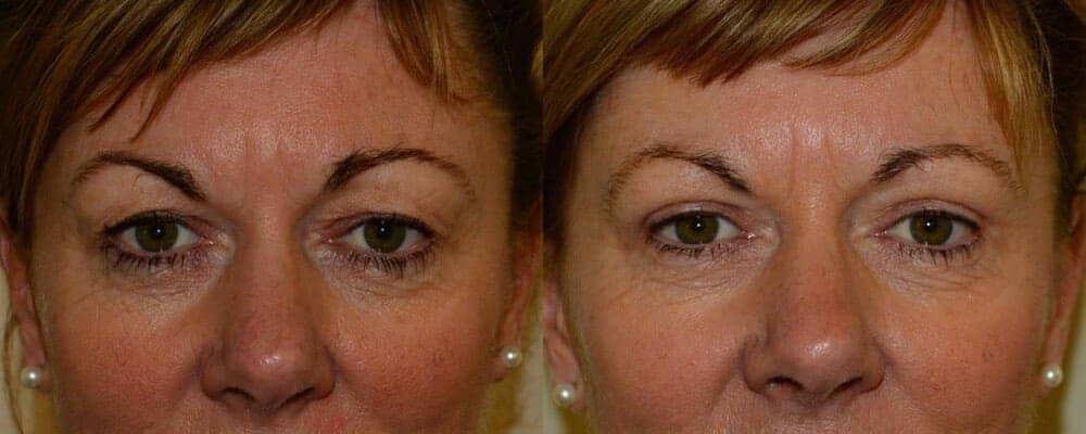 Upper blepharoplasty