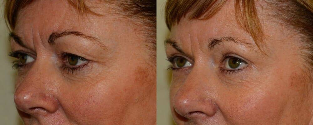 Upper blepharoplasty