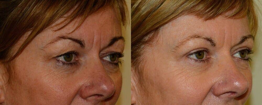 Upper blepharoplasty