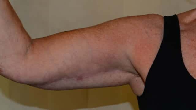 arm lift surgery bingo wings quaba plastic surgery edinburgh
