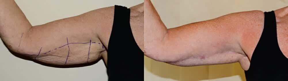 Arm lift surgery