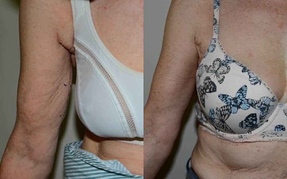 Arm lift / brachioplasty