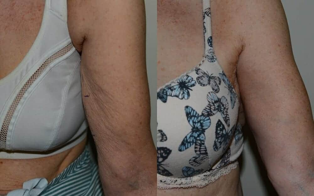 brachioplasty arm reduction edinburgh