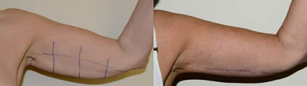 Arm reduction results at six months