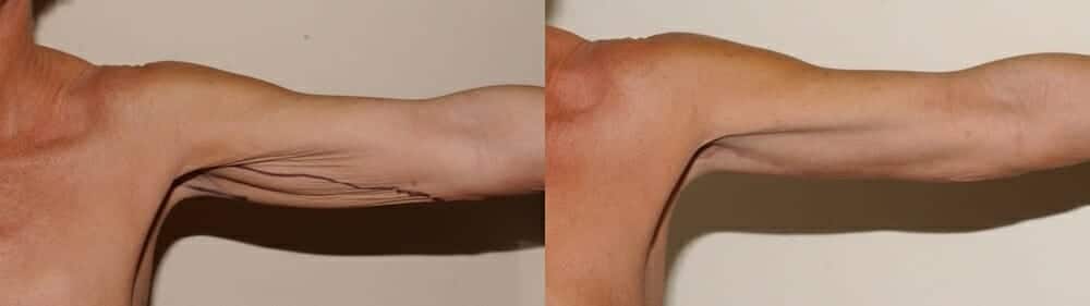 Arm lift / brachioplasty