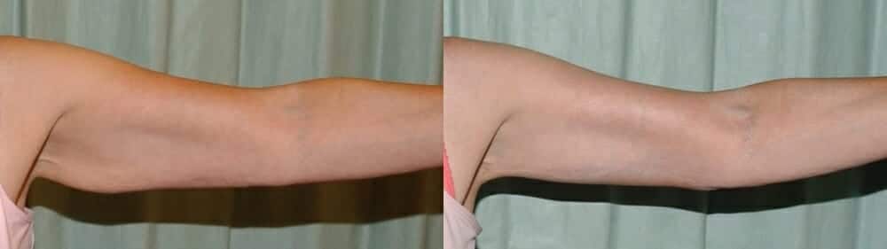 Arm lift scars long term