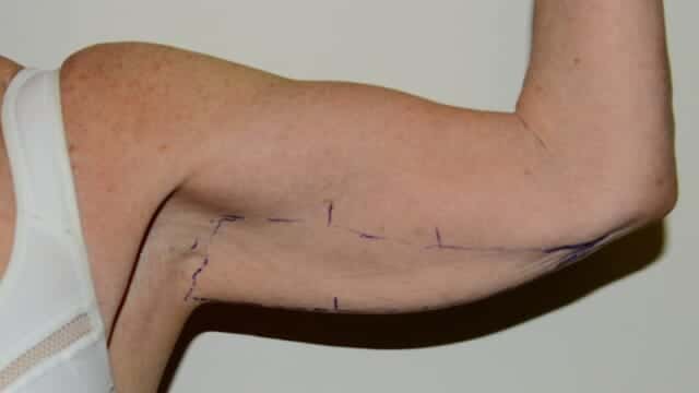 Arm lift / brachioplasty