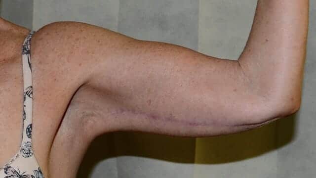 arm lift scarring edinburgh scotland