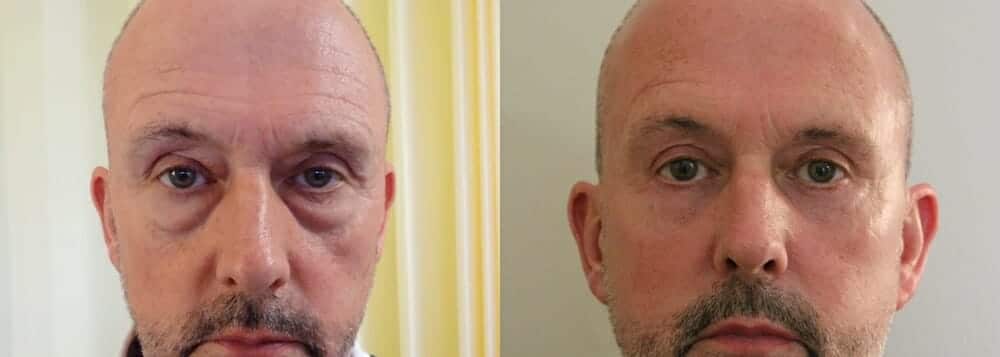 Upper and lower eyelids