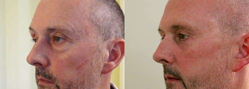 Upper and lower eyelids