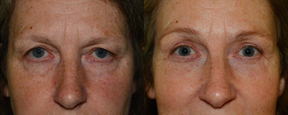 Upper and lower eyelid surgery with fat transfer