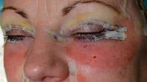 Extent of wounds and swelling 5 days after eyelid surgery