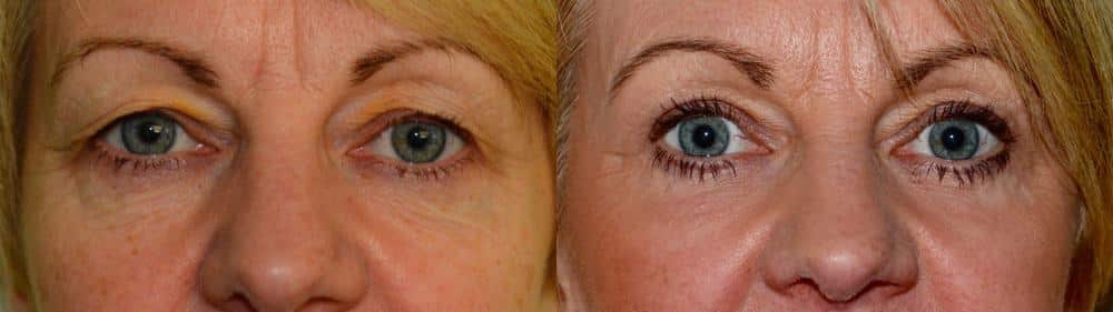 Upper and lower eyelid surgery with fat transfer and laser resurfacing