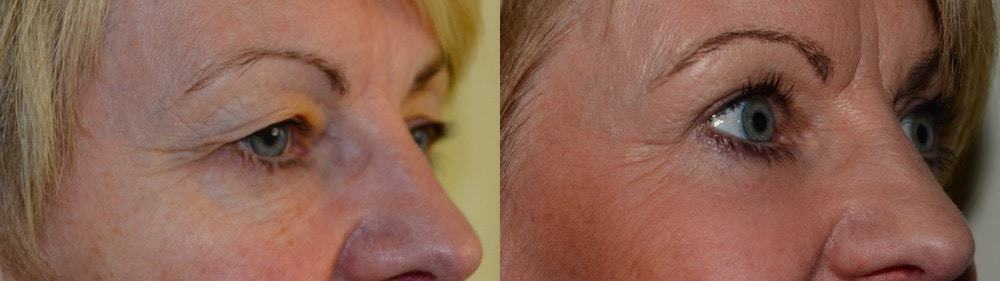 Upper and lower eyelid surgery with fat transfer and laser resurfacing