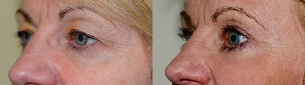Upper and lower eyelid surgery with fat transfer and laser resurfacing