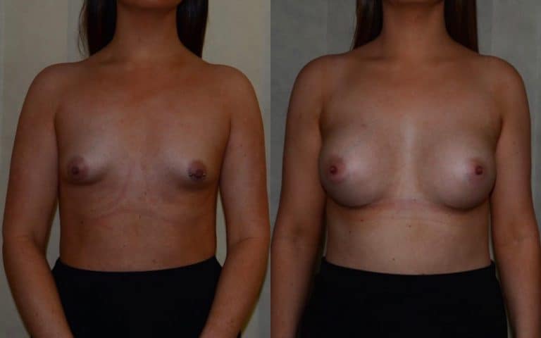 Breast enlargement before and after, photo 1 of 4