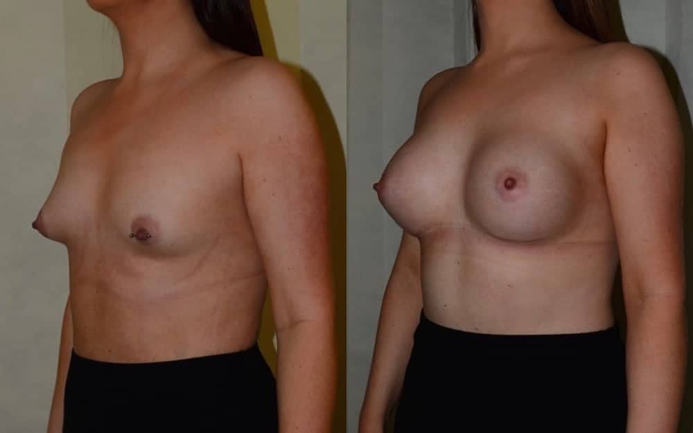 Breast enlargement