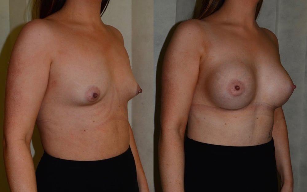 Breast enlargement