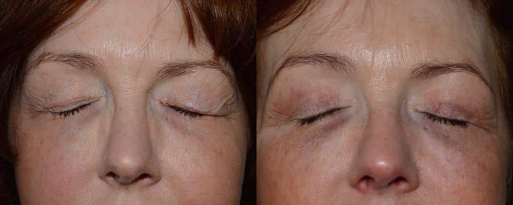 Upper eyelid surgery