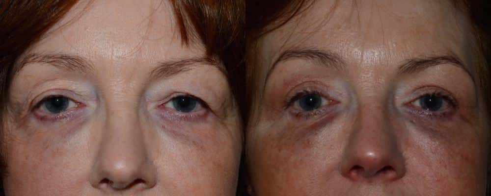 Upper eyelid surgery