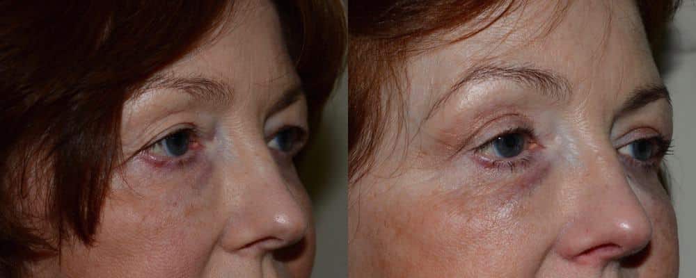 Upper eyelid surgery