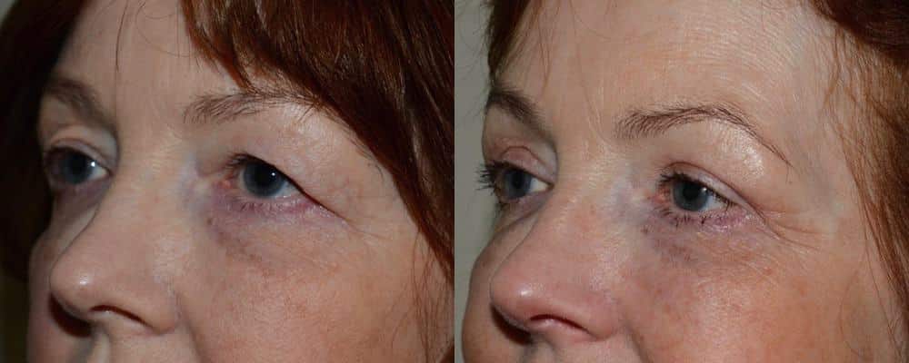 Upper eyelid surgery