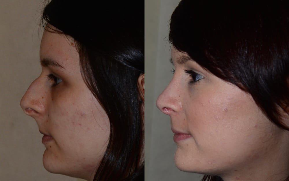 Hump reduction, tip refinement and reduction of columella